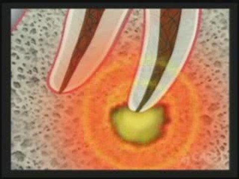 Tooth decay dentist|Tooth abscess|Glendale|Dr. Sahabi