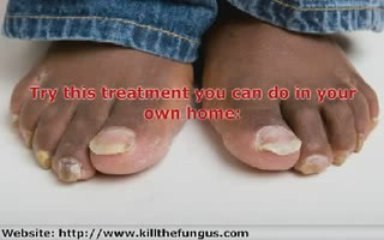 The best toenail fungus remedies and treatments.