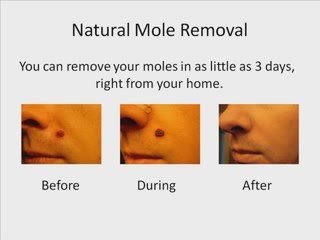 Natural Mole Removal "Natural Mole Removal"