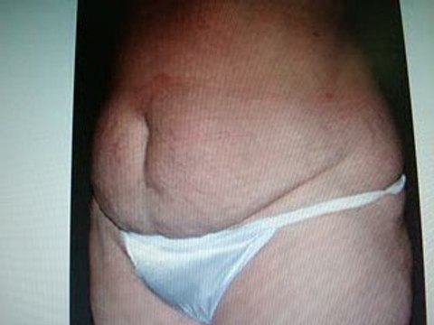 شد البطن-ازالة الترهلات-قطر-دبي-TUMMY TUCK IN DUBAI QATAR-