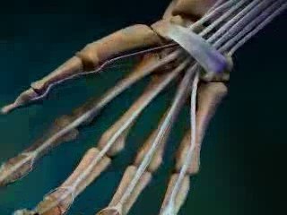 Carpal Tunnel Syndrome