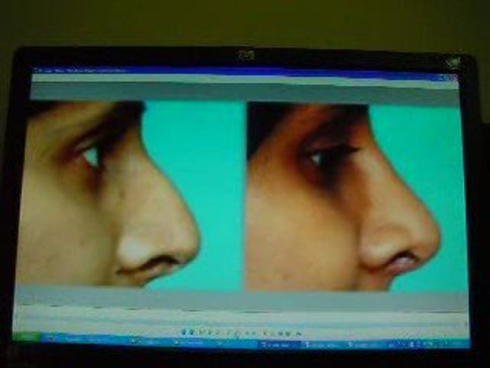 تجميل  الانف-منخار-عملية تجميل الانف-جراحة الانف-قطر-دبي-