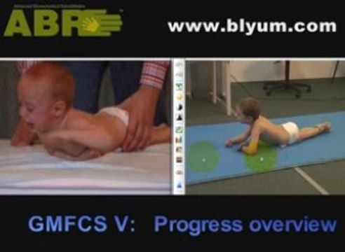 Cerebral Palsy Child Development Progress,Quadriplegic Boy