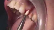 ZIRCONIA DENTAL IMPLANT