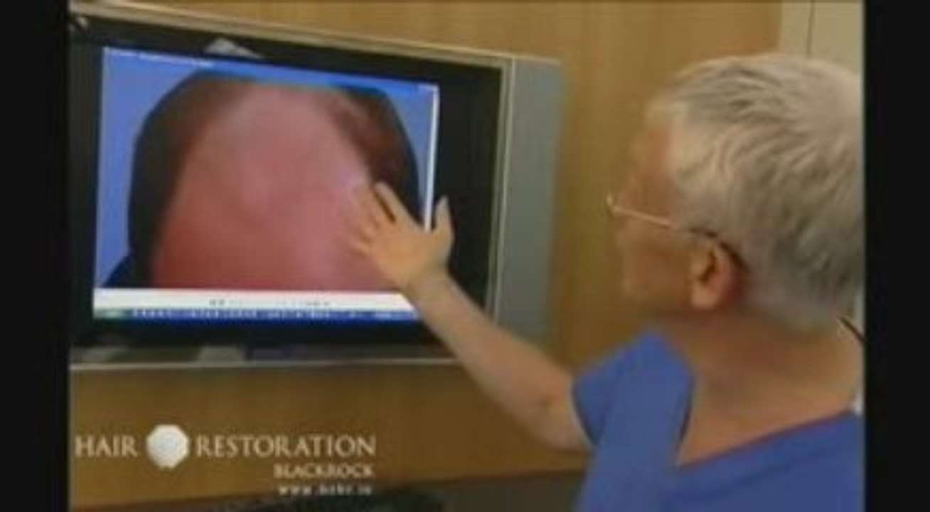 Dr. Maurice Collins from HRBR talks about Hair Loss - Part 2