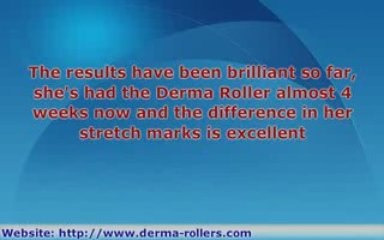 Derma Roller Stretch Mark Removal Review
