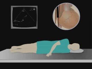 What is TEE? Explanation of Transesophageal Echocardiography