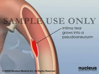 False Aortic Aneurysm with Rupture of the Aorta