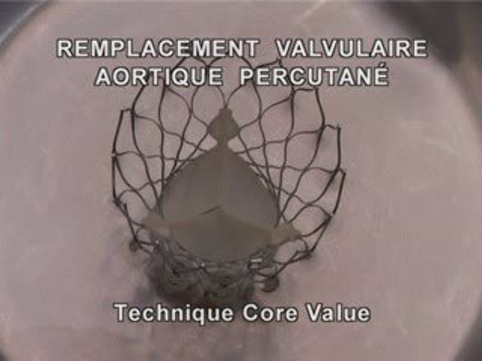 Pose d'une valve aortique percutanée Corevalve.