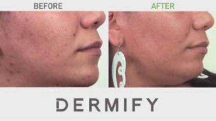 Follow our journey to Beat Acne and get Clear Skin