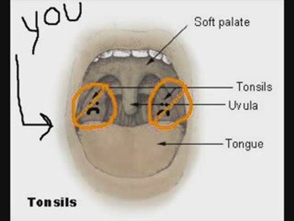 Why do people ignore tonsil stones? - what are they?