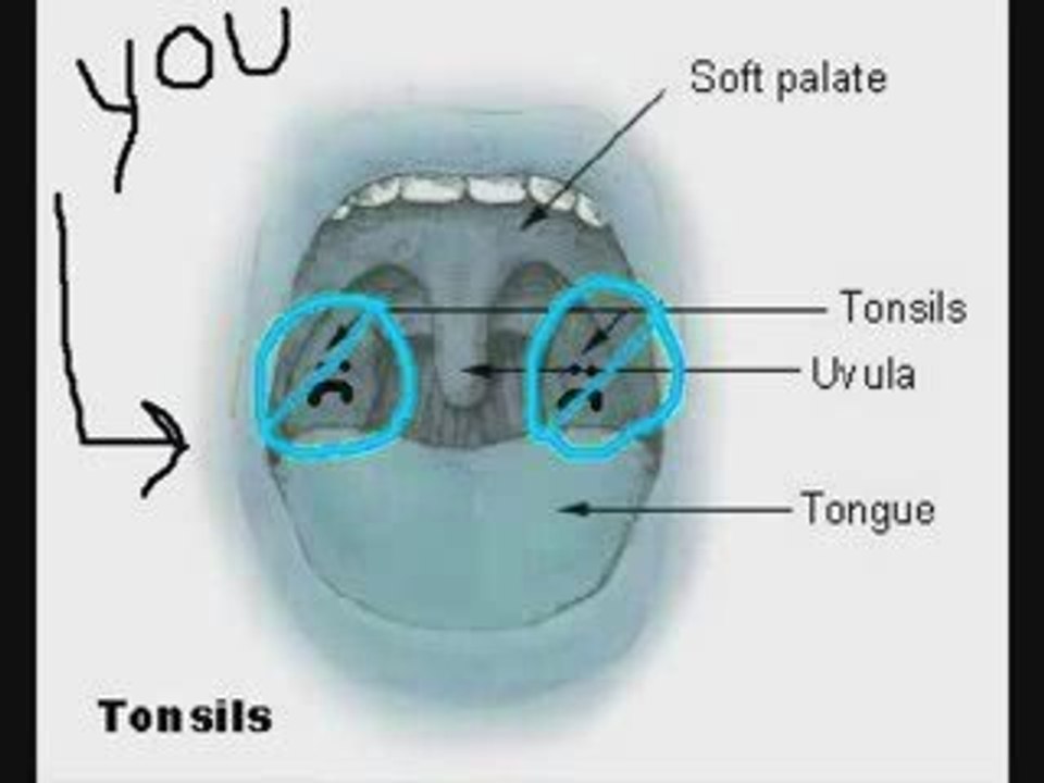 Alternative Tonsil Stones Tretament - Bad Breath Remedy