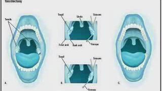 Tonsil Stones Treatment - How to Erase Tonsil Stones?