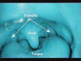 What is Tonsil Stones - Can they be Removed?
