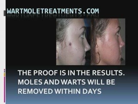 How To Get Rid Of Your Moles