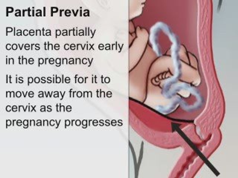 Pregnancy Risks -- Placenta Previa