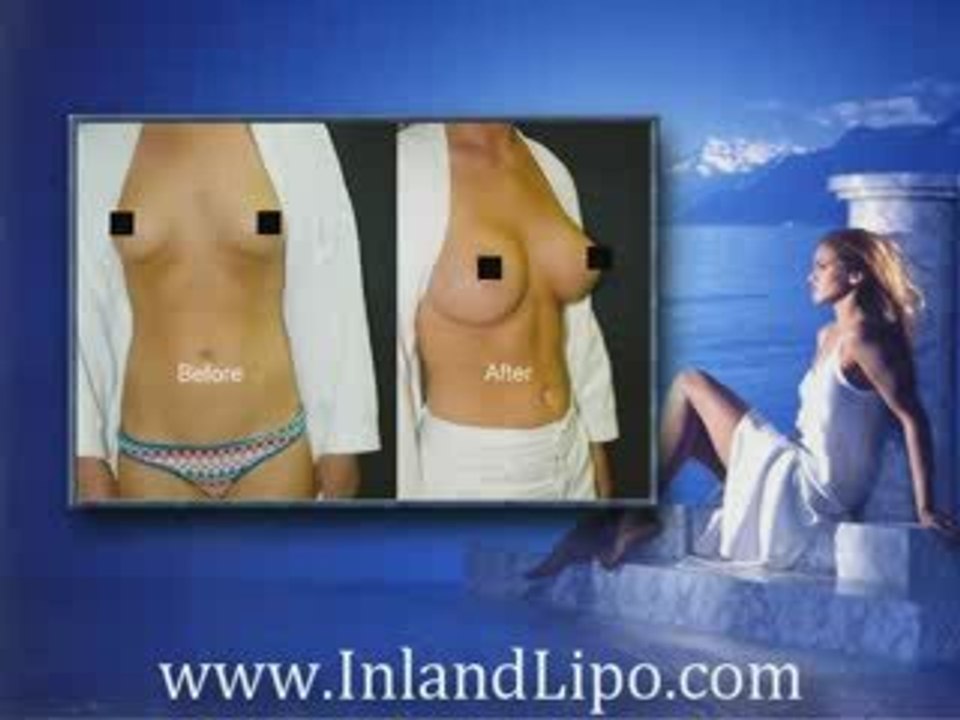 Temecula Breast Augmentation | Breast Implants Temecula Ca.
