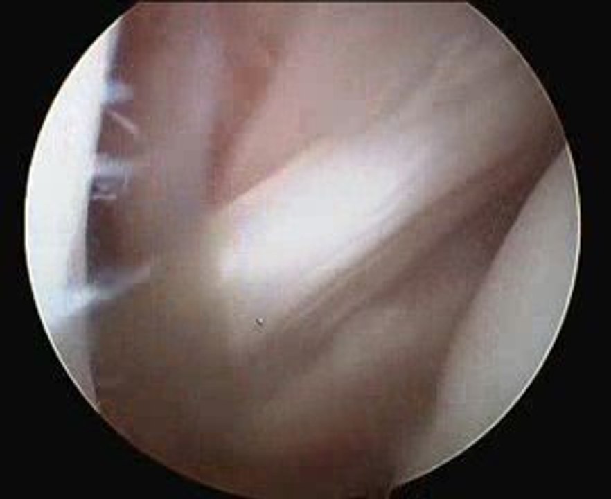 Arthroscopie de l'épaule !!