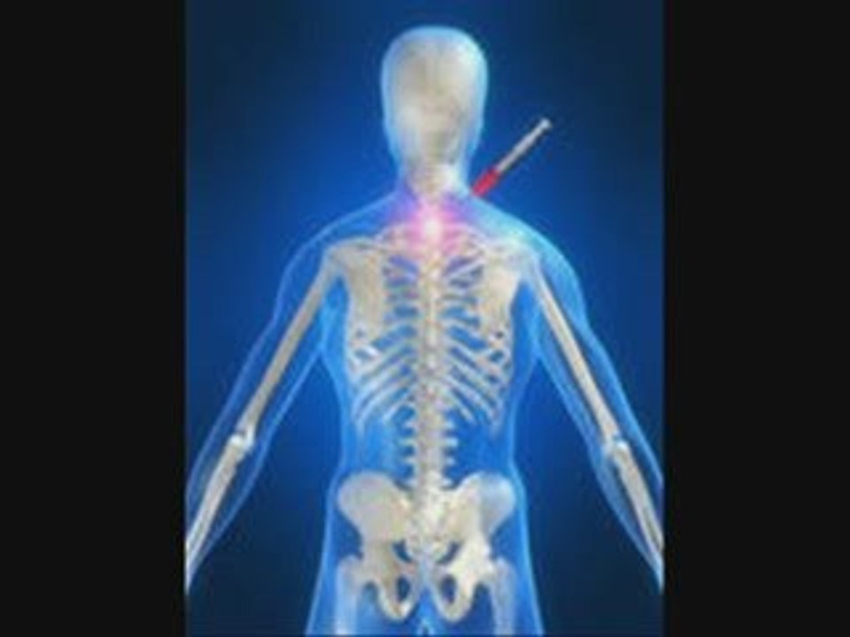 Pewaukee Chiropractor Whiplash Car Accidents