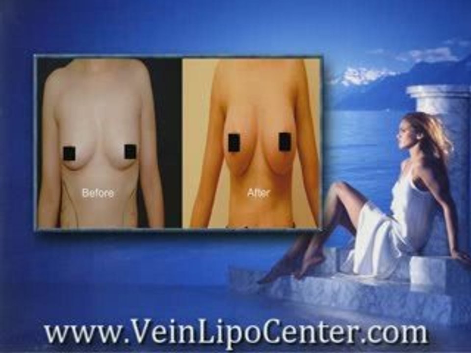Breast Implants San Diego | San Diego Breast Augmentation