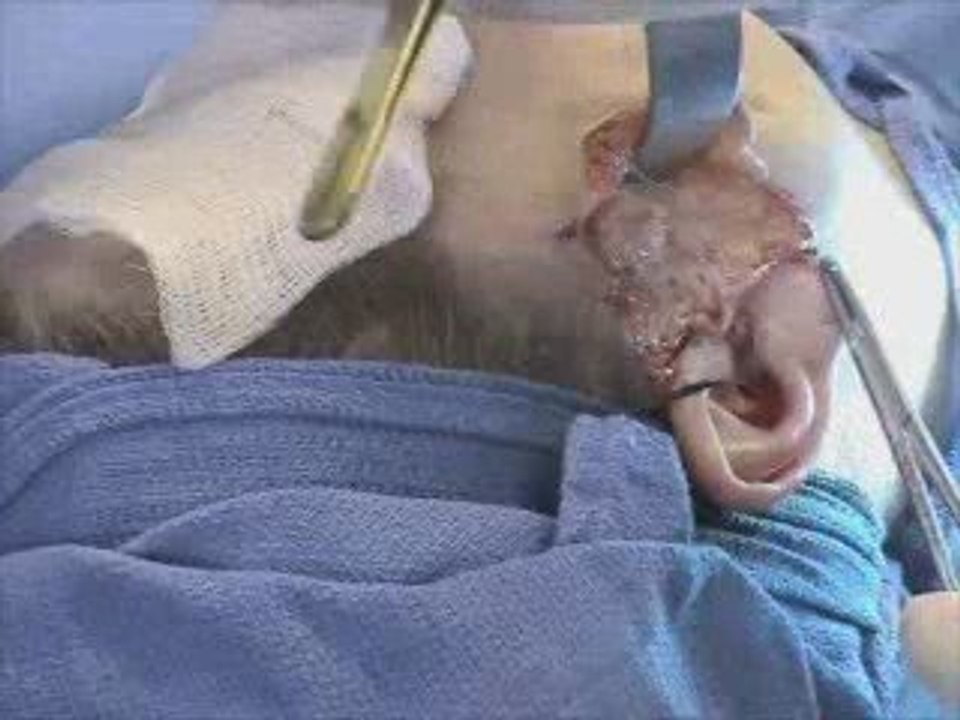 Dr. Salzman Performs Mini Face-Lift