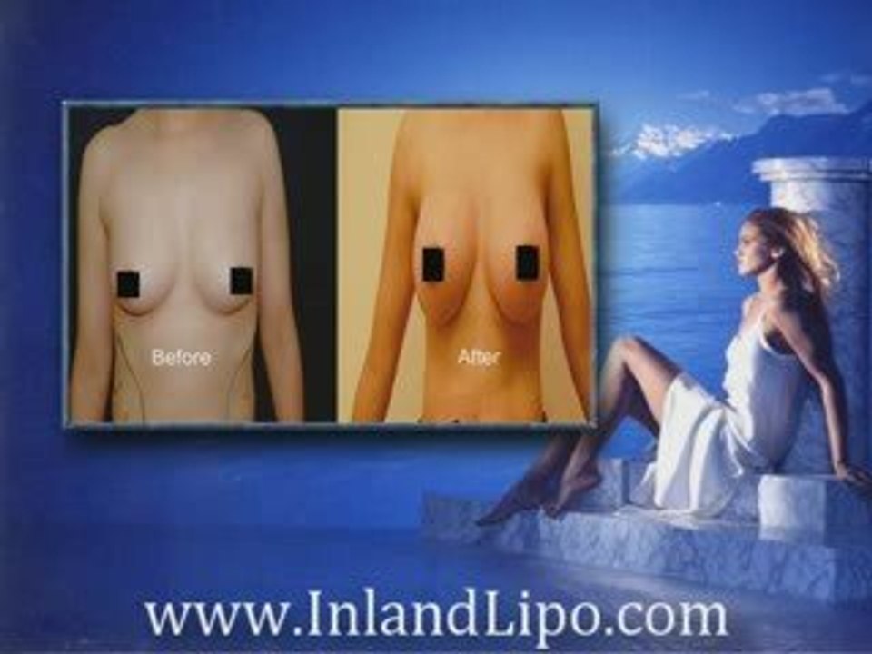 Temecula Breast Augmentation | Breast Implants Temecula Ca.