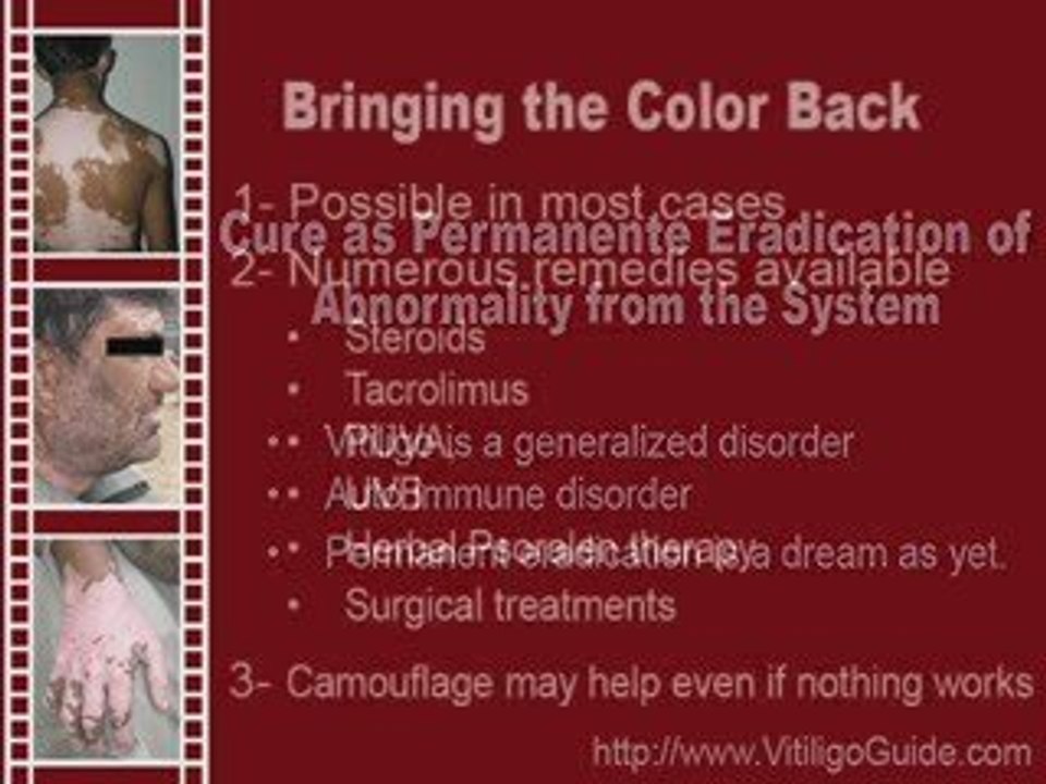 Vitiligo Cure