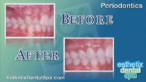 Periodontics - Gum Disease Treatment in Manhattan & Brooklyn
