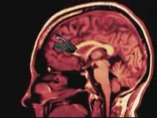 Tractografia: De los axones a los tractos