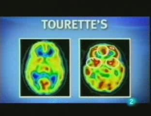 "Asuntos del cerebro": Psiquiatria infantil y neuroimagen