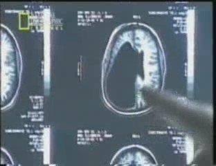 Plasticidad cerebral competitiva: Michelle