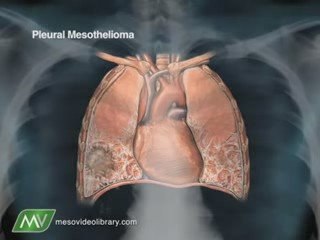 Mesothelioma Asbestos Cancer