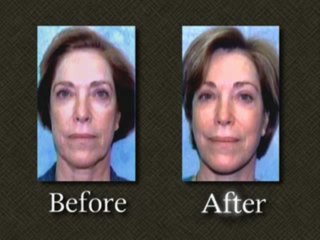 Washington DC Facelift Revison Surgery Case 2 - Dr. Mark E.