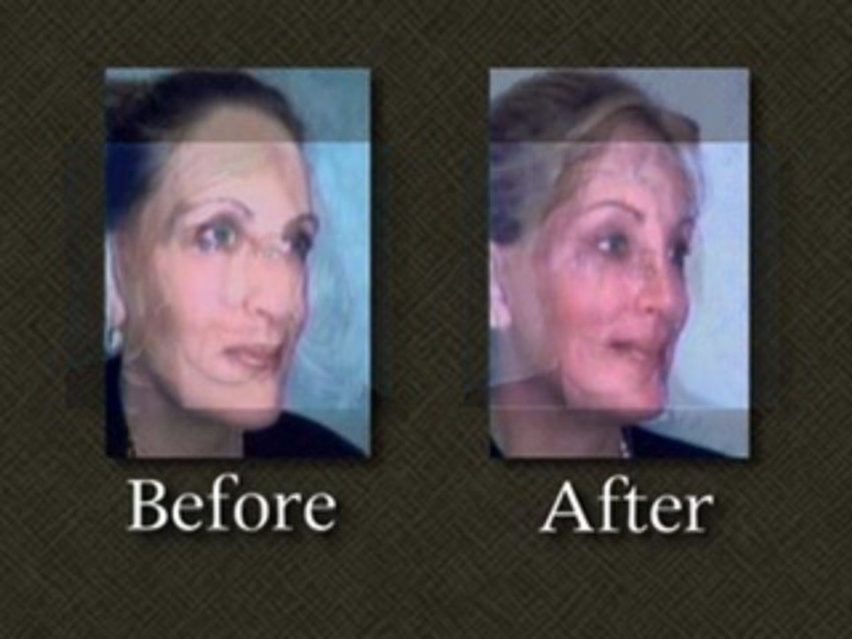 linda tripp plastic surgery Image 6