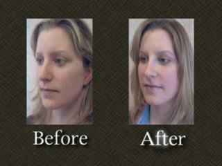 Washington DC Rhinoplasty Patient Results  Dr. Richards