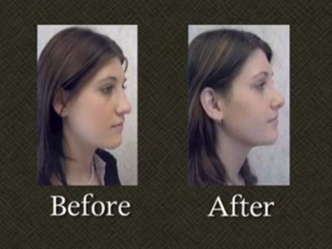 Rhinoplasty Nose Surgery Gallery Maryland Dr. Mark Richards