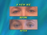 Maryland Eyelid Surgery Results Gallery - Dr. Mark Richards