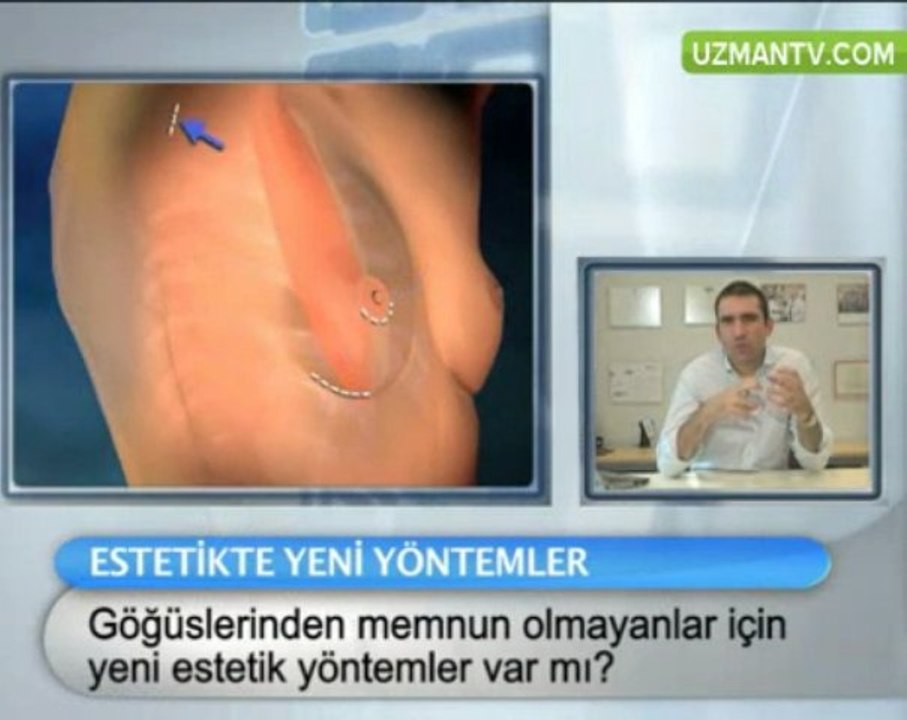 Göğüslerinden memnun olmayanlar için yeni estetik yöntemler
