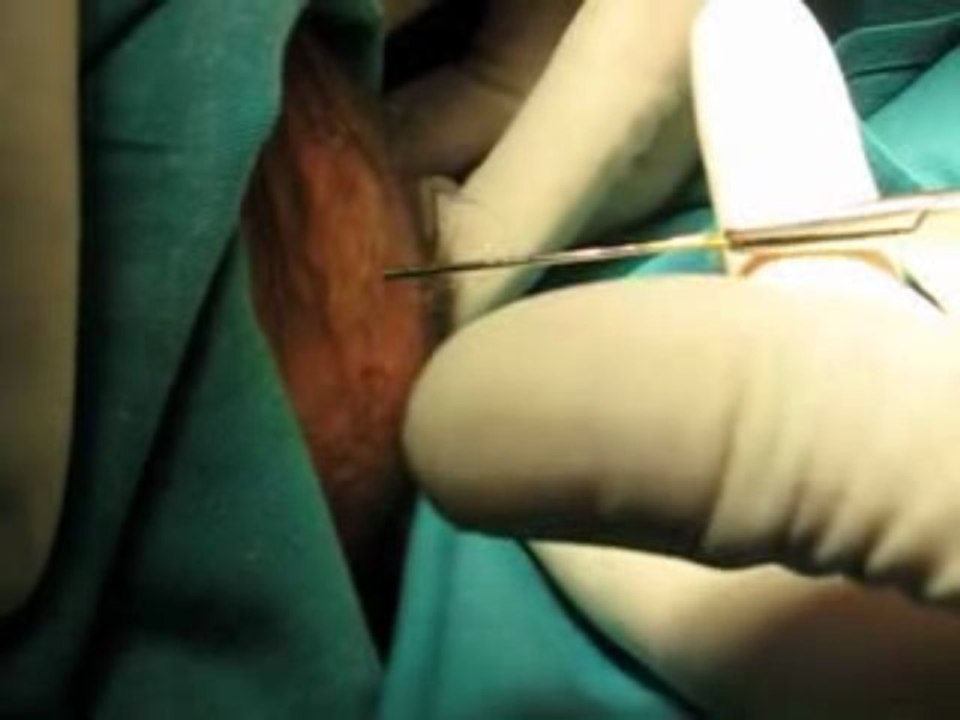 Take the 10 cm nail out of the baby's head