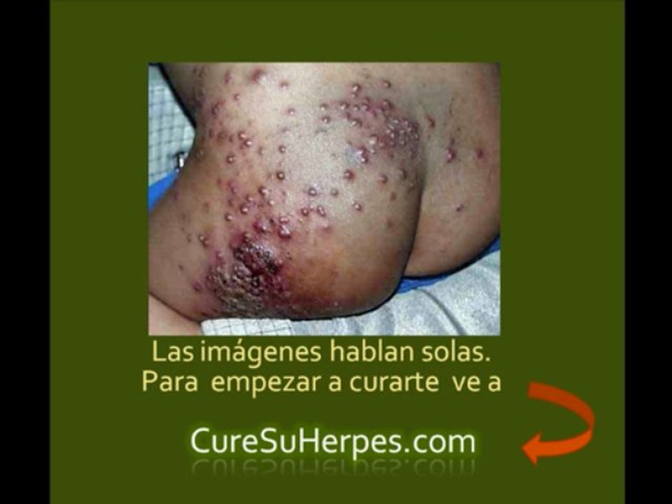 Deje Atras el Herpes - Tratamiento Para Curar lo
