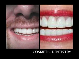 DR JJ EDDERAI COSMETIC ONE HOUR TEETH WHITENING TEENAGERS