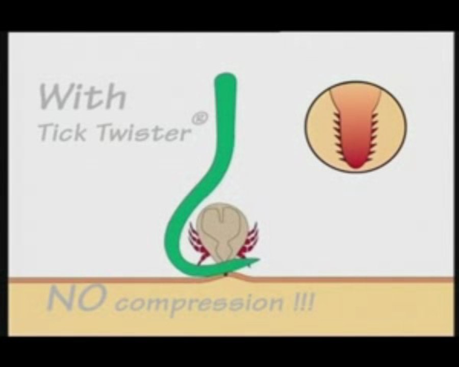 It is essential not to compress a tick when removing it