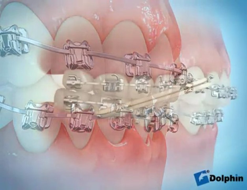 Damon self-ligating bracket system