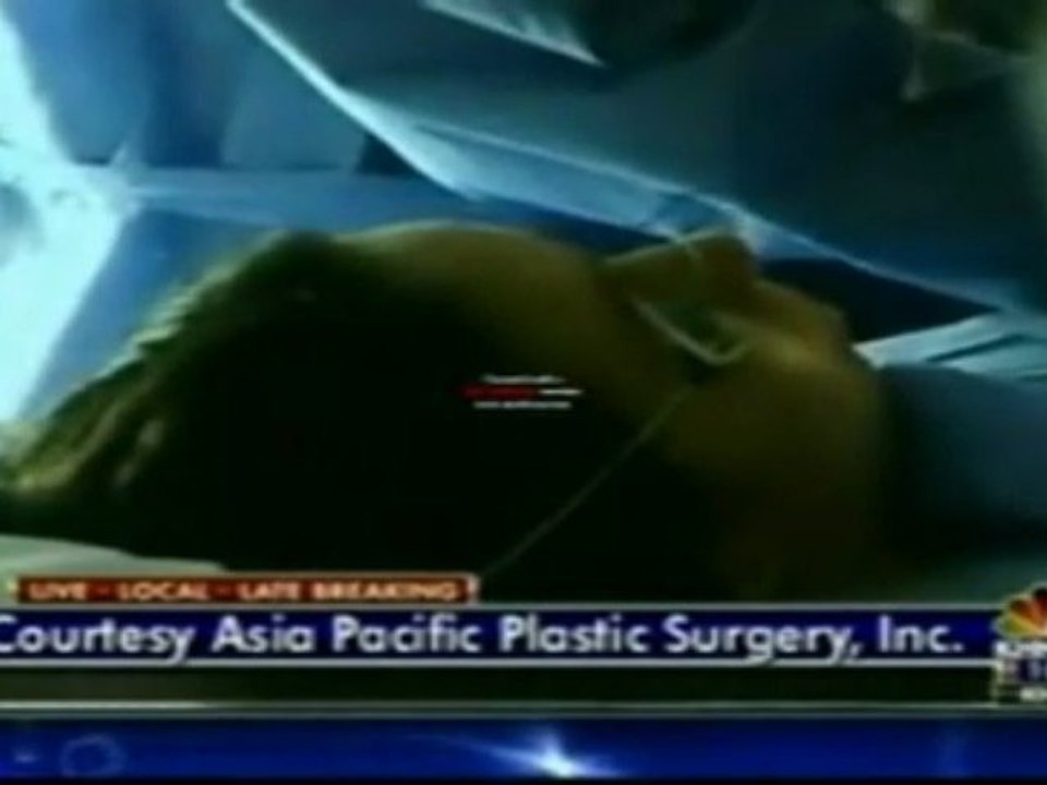 LaserLipo Guide - Frank Peterson
