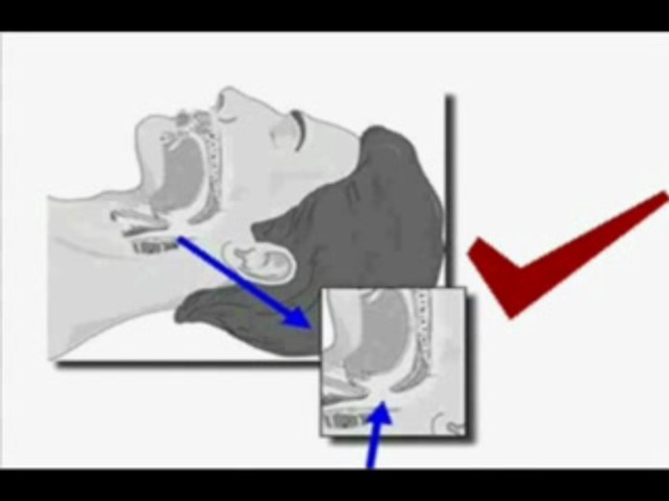 The Ultimate Anti Snoring Mouthpiece
