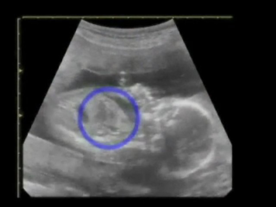 Fetal ultrasound