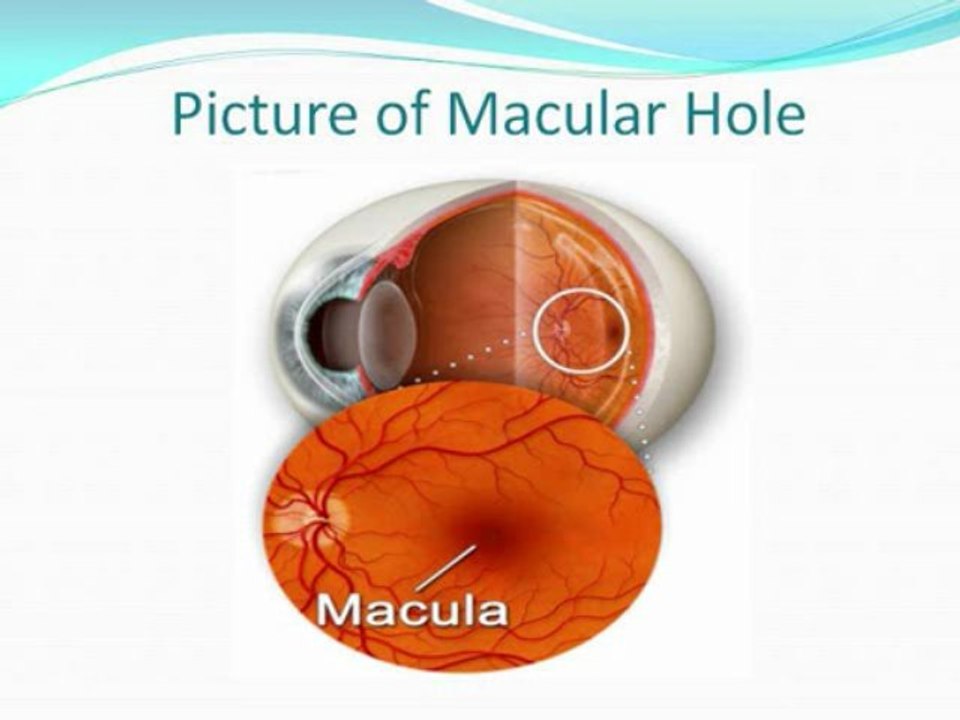 Vitrectomy Recovery Solutions LLC Support Group