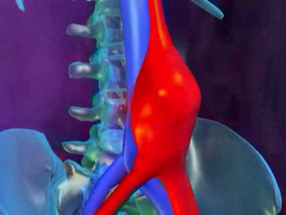 Abdominal Aortic Aneurysm