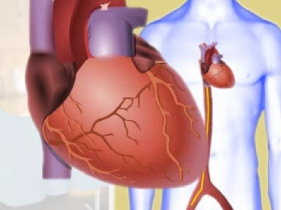 Electrophysiologic Study (EPS)