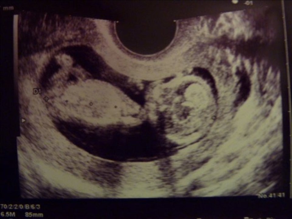 Premiers battements de coeur de notre bébé